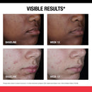 Stubborn Marks PM Treatment with Retinol SA, Face-Exfoliating Treatment to Help Reverse the Look of Post-Acne Marks & Uneven Skin Tone, Oil-Free, Non-Comedogenic, PM Treatment, Unscented, 1.0 Fl Oz