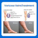 VascuRelief: Powerful Ointment for Varicose Veins and Spider Vein Pain Relief