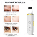 Ultrasonic Facial Skin Scrubber: 4 Modes for Deep Cleansing & Blackhead Removal